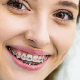 Jaka szczoteczka do aparatu ortodontycznego sprawdzi się najlepiej?